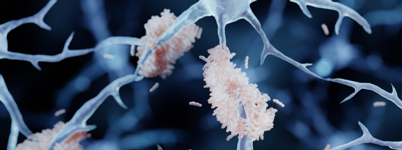 Amyloid plaques in alzheimer's disease